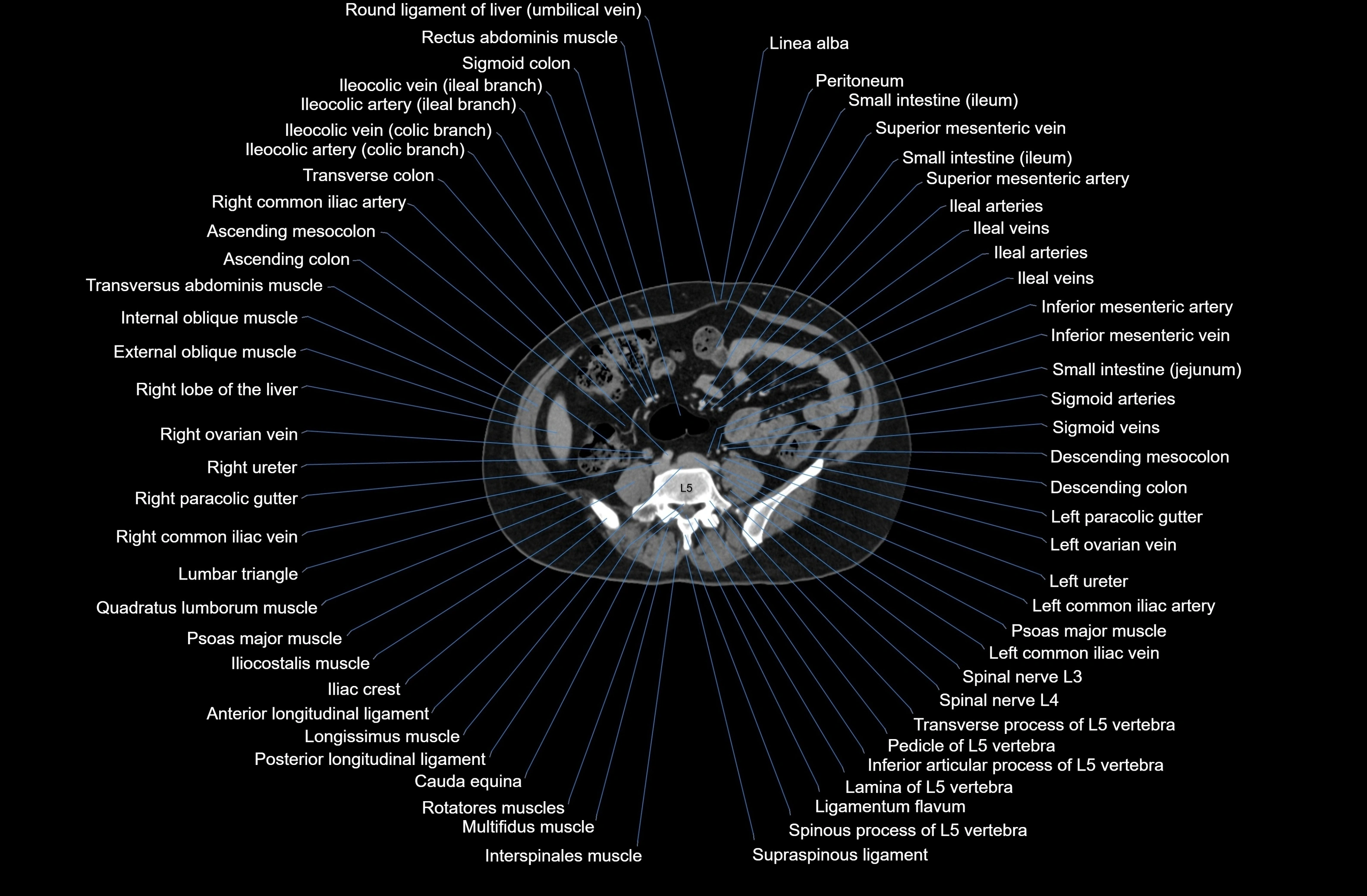 CT Abdomen axial cross sectional anatomy labelled radiology image-00058.webp